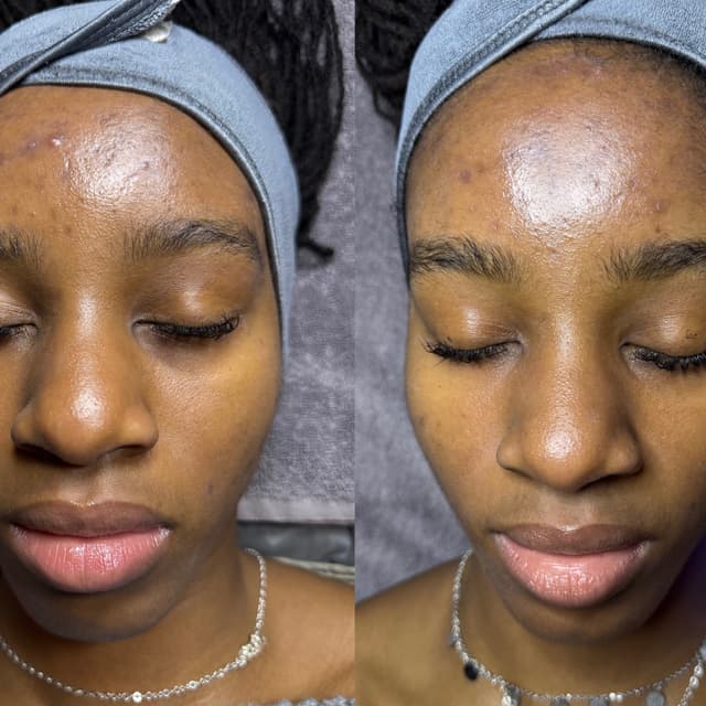 Microneedling Package at Oasiah Aesthetics in New York, NY