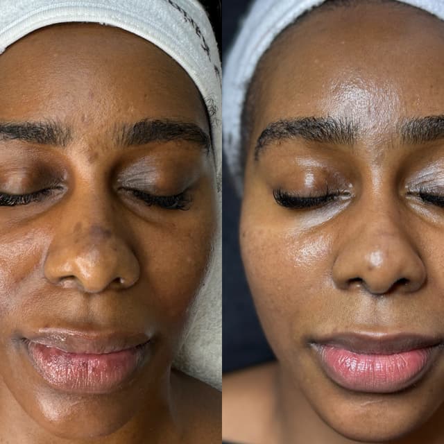 VI Peel Package at Oasiah Aesthetics in New York, NY