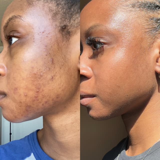 Pigment Correct Peel Package at Oasiah Aesthetics in New York, NY
