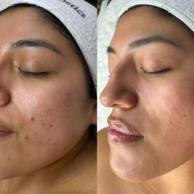 TCA Light Chemical Peel Package at Oasiah Aesthetics in New York, NY